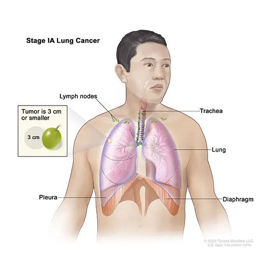 lung cancer 4 marker panel